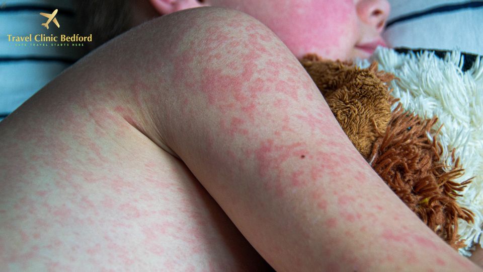 Measles symptoms